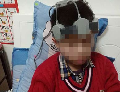 家用经颅磁治疗仪治疗